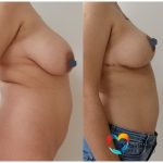Detailed photograph highlighting the refined results of plastic surgery procedures on facial symmetry and aesthetics.