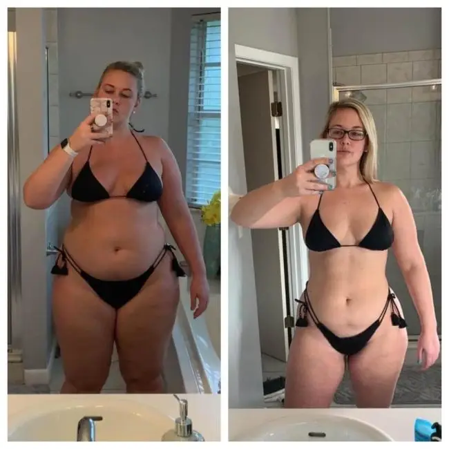 Gastric Sleeve Surgery at Tijuana Mexico