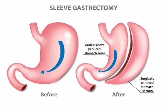 Sleeve Gastrectomy