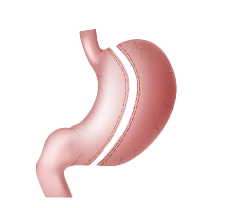 What is Gastric Sleeve Surgery?