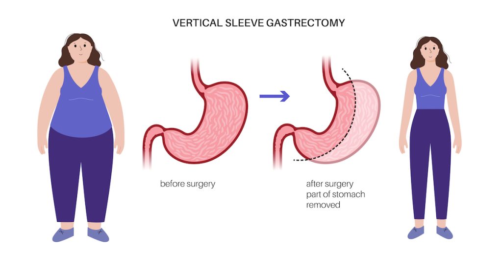 Gastric Sleeve Surgery is also known as sleeve gastrectomy