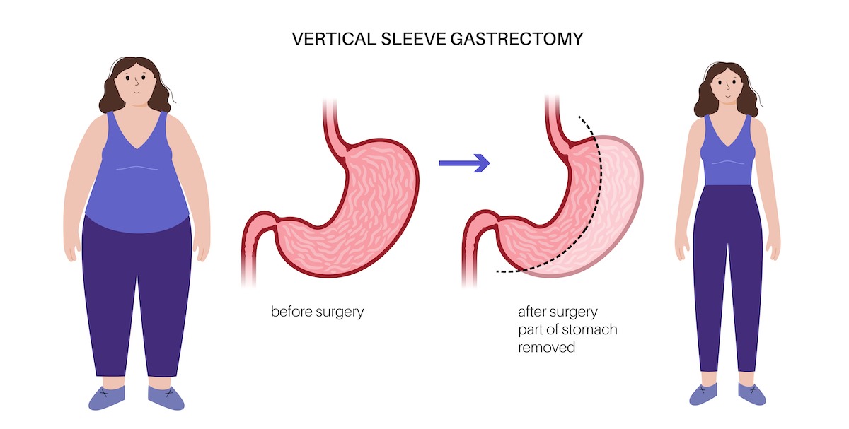 Gastric Sleeve Surgery Mexico