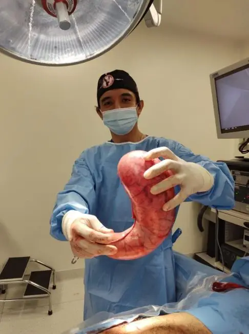 Gastric Sleeve Operationis the right choice for you.