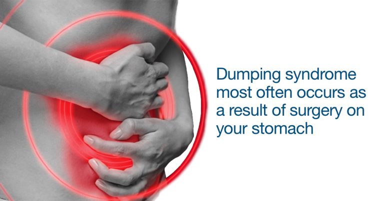 Dumping syndrome most often occurs as a result of surgery on your stomach or esophagus.