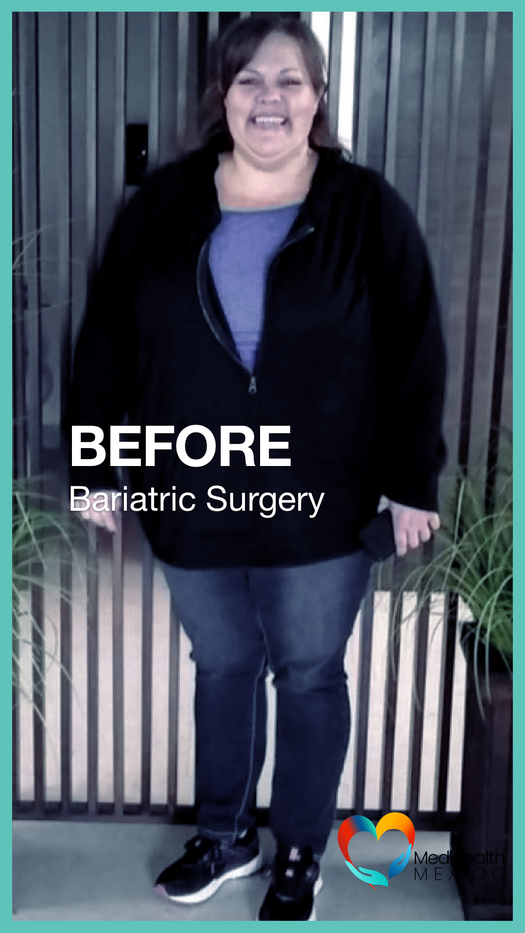 Bariatric Surgery, Plastic Surgery, USA, Tijuana Mexico