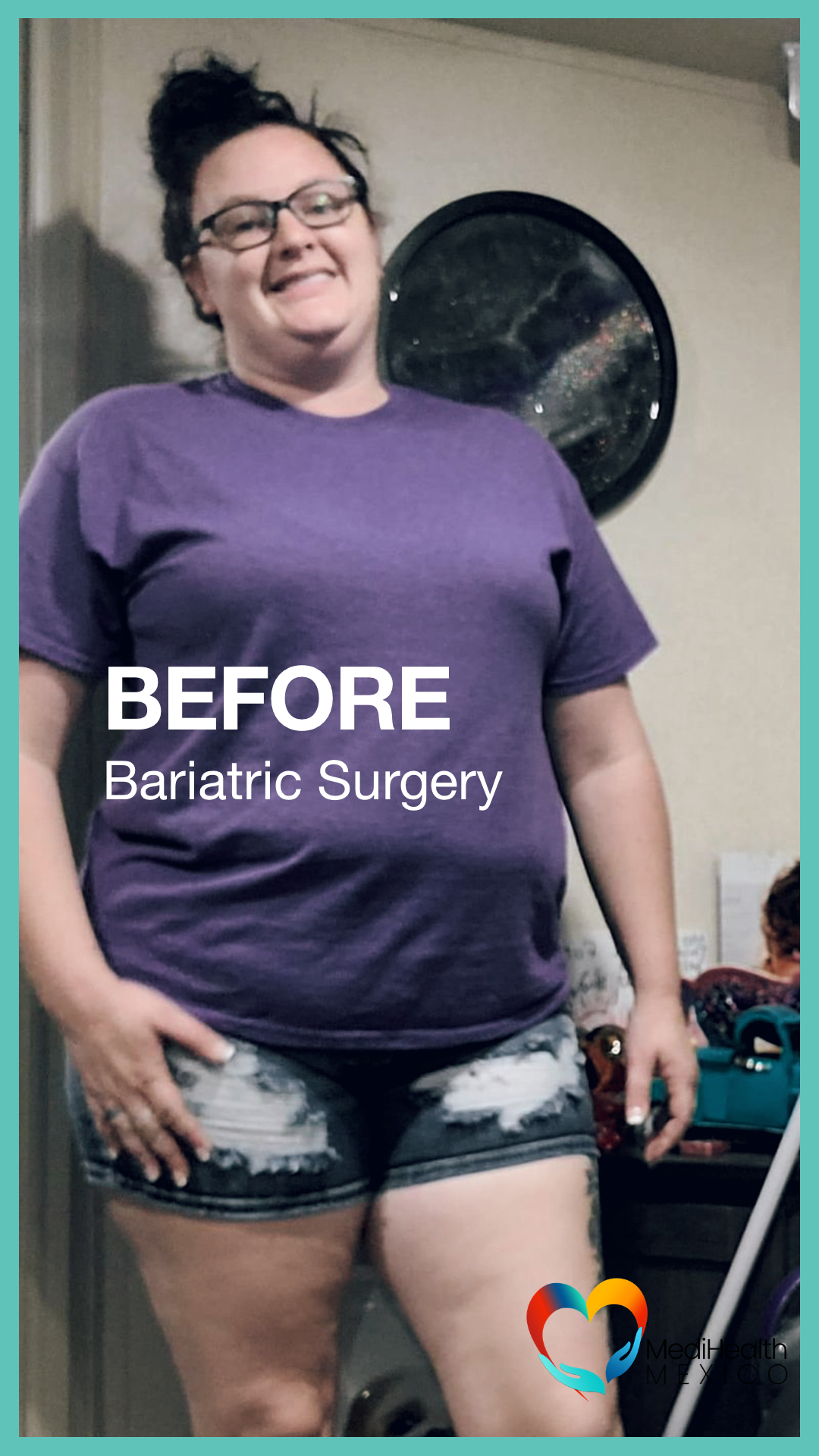 Bariatric Surgery, Plastic Surgery, USA, Tijuana Mexico