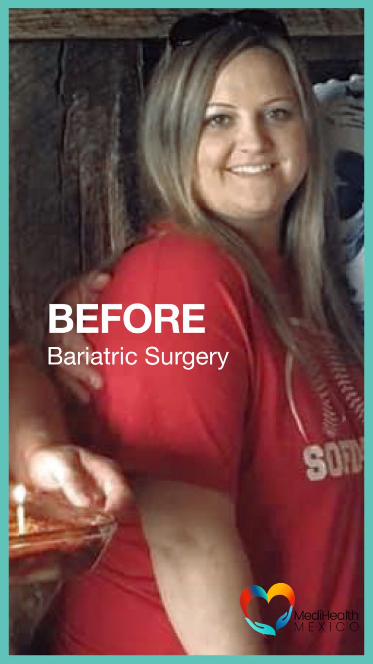 Bariatric Surgery, Plastic Surgery, USA, Tijuana Mexico