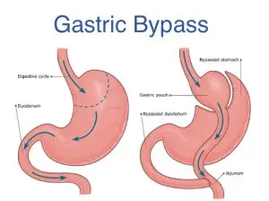 RNY gastric bypass