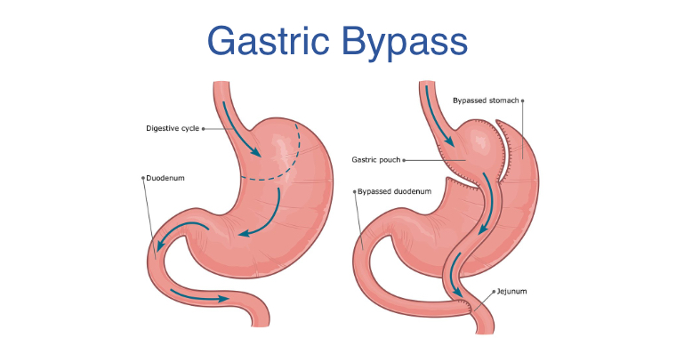 RNY gastric bypass