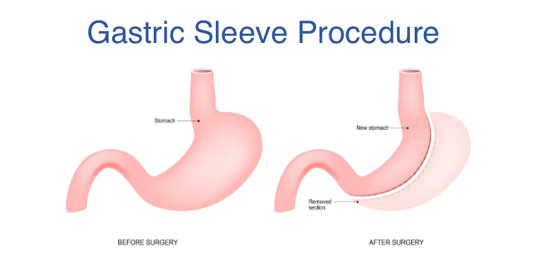 Gastric Sleeve procedure