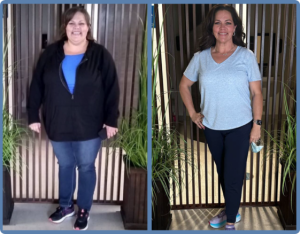 Before and After Bariatric Surgery