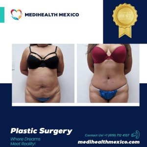 A Mommy Makeover combines cosmetic procedures designed to address physical changes that can occur after pregnancy and childbirth.