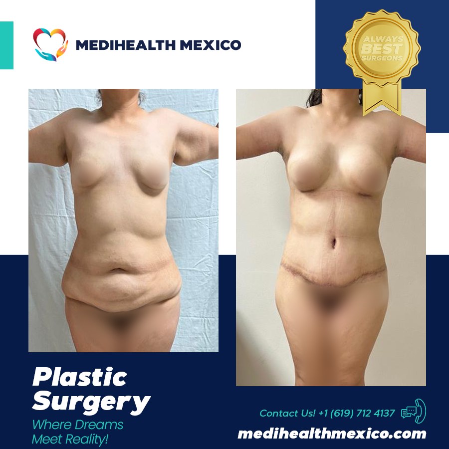 A Mommy Makeover combines cosmetic procedures designed to address physical changes that can occur after pregnancy and childbirth.