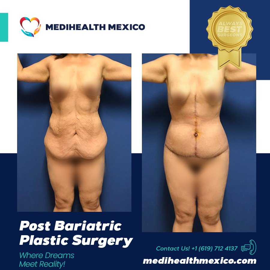 A Mommy Makeover combines cosmetic procedures designed to address physical changes that can occur after pregnancy and childbirth.
