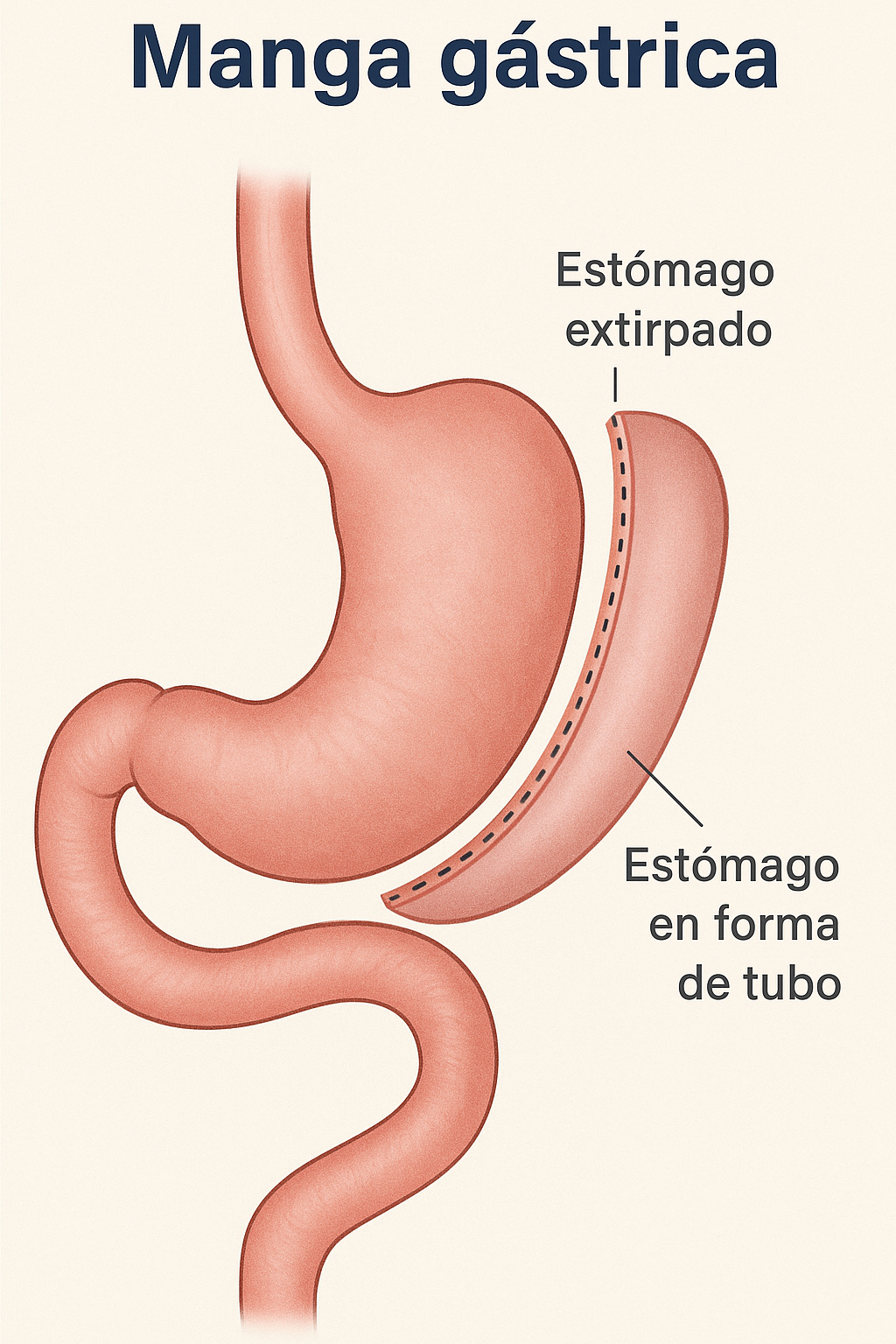 ¿En qué consiste la cirugía de gastric sleeve?