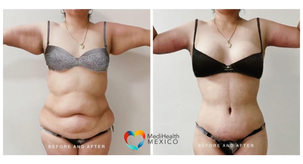 Â skin removal after bariatric surgery
