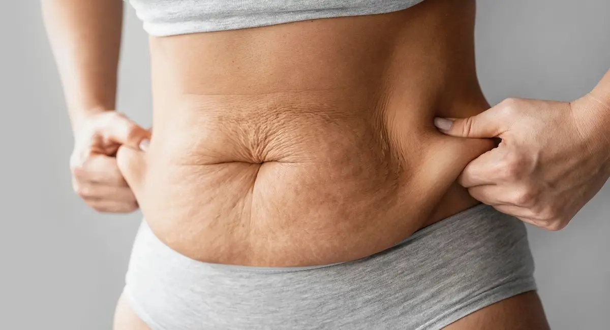 Do You Need Skin Removal Surgery After Bariatric Surgery?