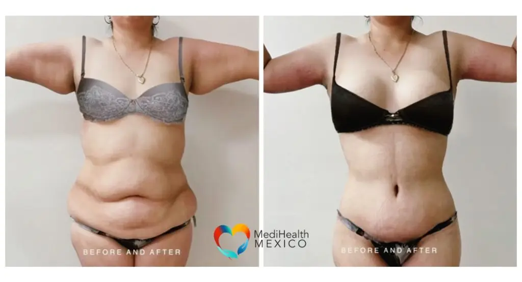 Need Skin Removal Surgery Before After