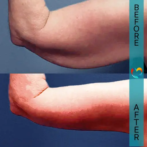 Arm Lift (brachioplasty) Surgery for Toned Arms