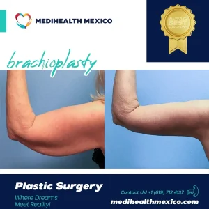 Plastic Procedure Before and After, MediHealth Mexico