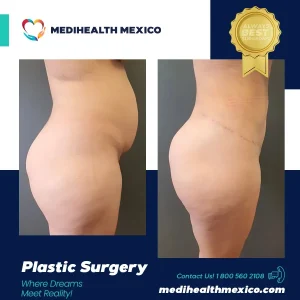 Plastic Procedure Before and After, MediHealth Mexico