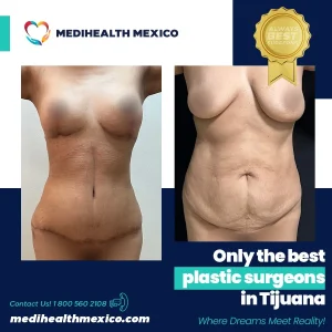 Plastic Procedure Before and After, MediHealth Mexico