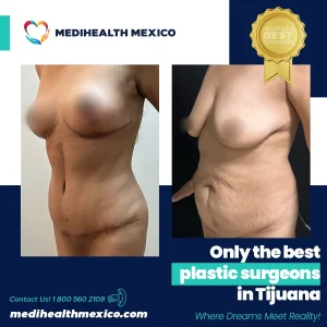 Plastic Procedure Before and After, MediHealth Mexico