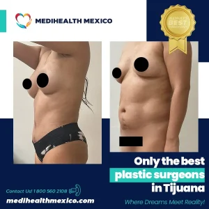 Plastic Procedure Before and After, MediHealth Mexico