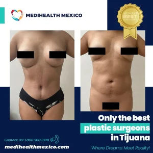 Plastic Procedure Before and After, MediHealth Mexico