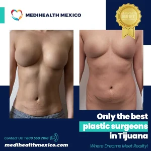 Plastic Procedure Before and After, MediHealth Mexico
