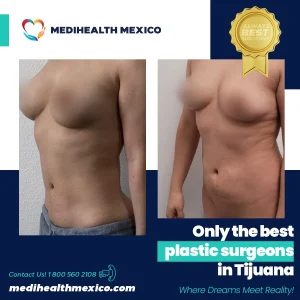 Plastic Procedure Before and After, MediHealth Mexico