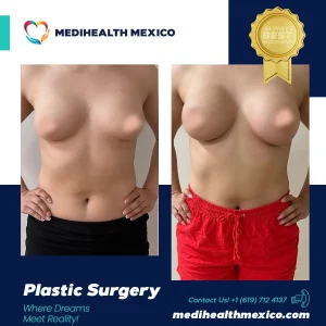 Plastic Procedure Before and After, MediHealth Mexico