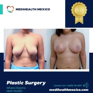 Plastic Procedure Before and After, MediHealth Mexico