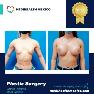 Plastic Procedure Before and After, MediHealth Mexico