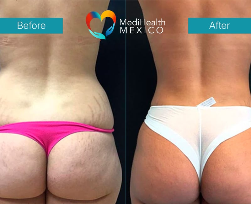 Transform Your Curves with a Brazilian Butt Lift
