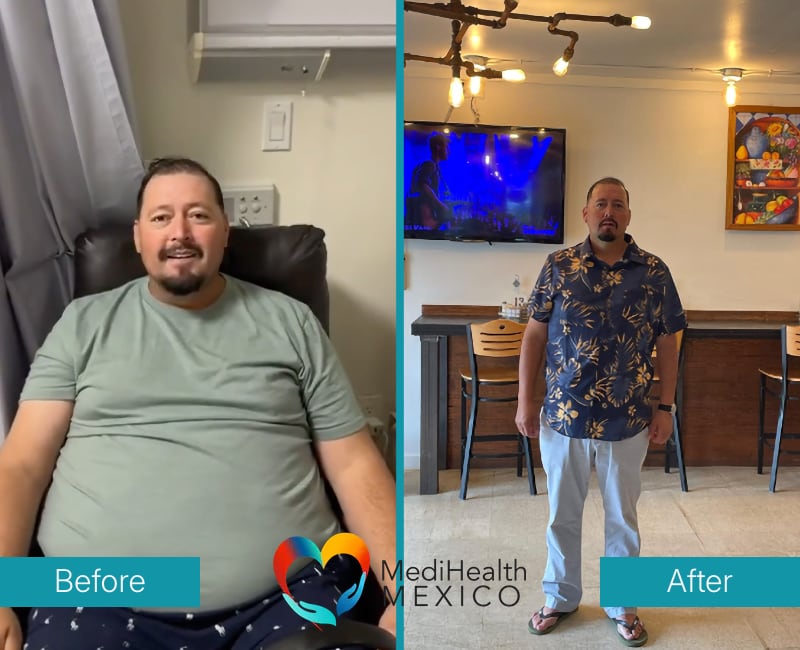 Before and After Bariatric Surgery 0001