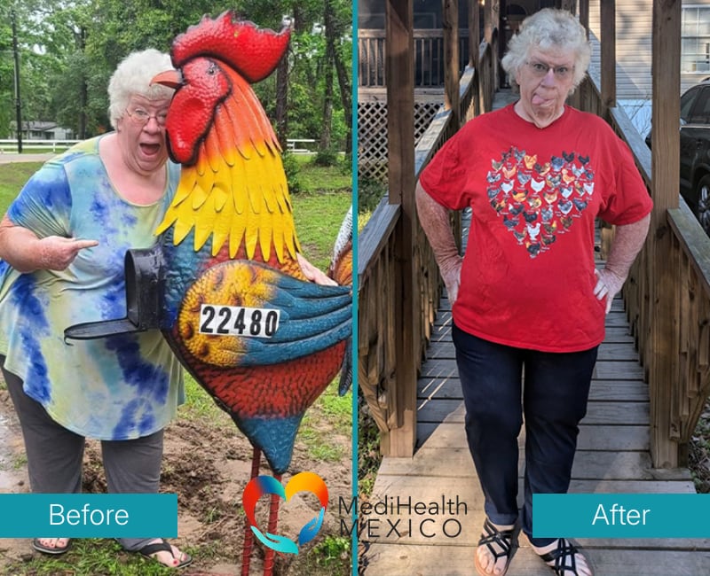 Before and After Bariatric Surgery 0001