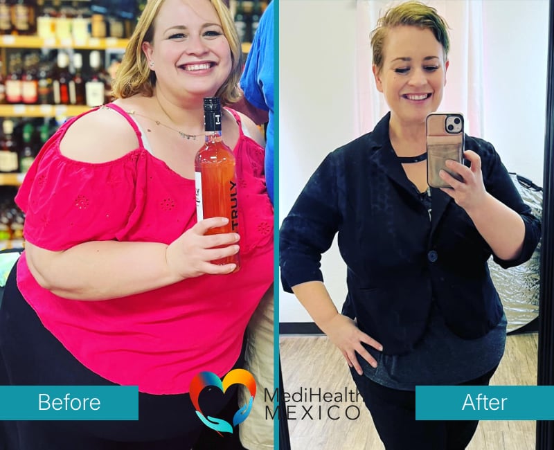 Before and After Bariatric Surgery 0001