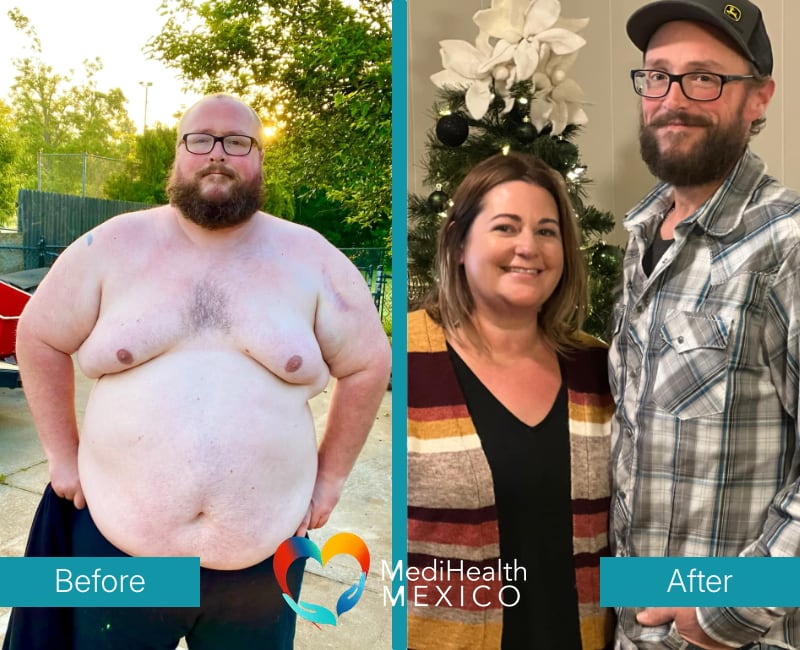 Before and After Bariatric Surgery 0001