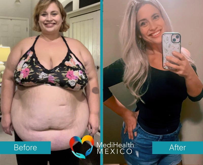 Before and After Bariatric Surgery 0001