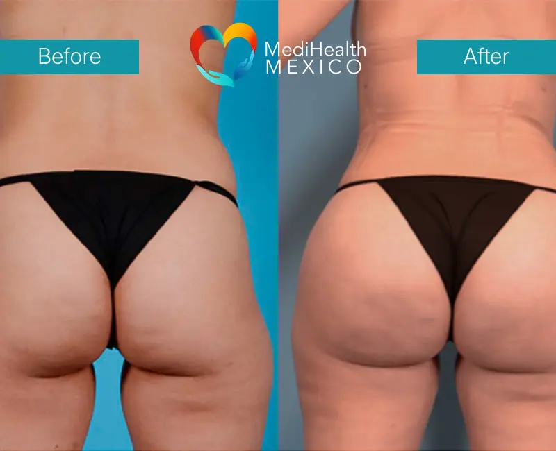 Transform Your Curves with a Brazilian Butt Lift