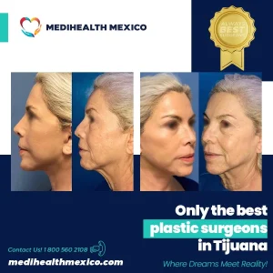 Plastic Procedure Before and After, MediHealth Mexico