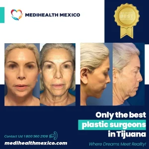 Plastic Procedure Before and After, MediHealth Mexico