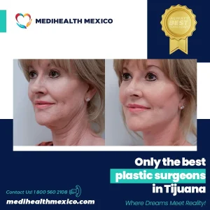 Plastic Procedure Before and After, MediHealth Mexico