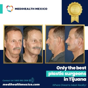 Plastic Procedure Before and After, MediHealth Mexico
