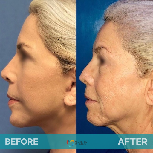 Facelift Before and After