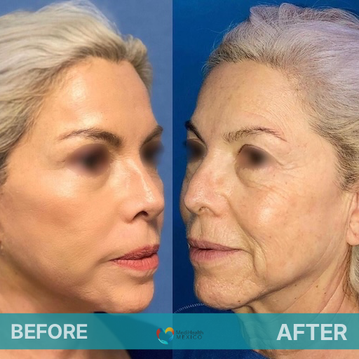 Facelift Before and After