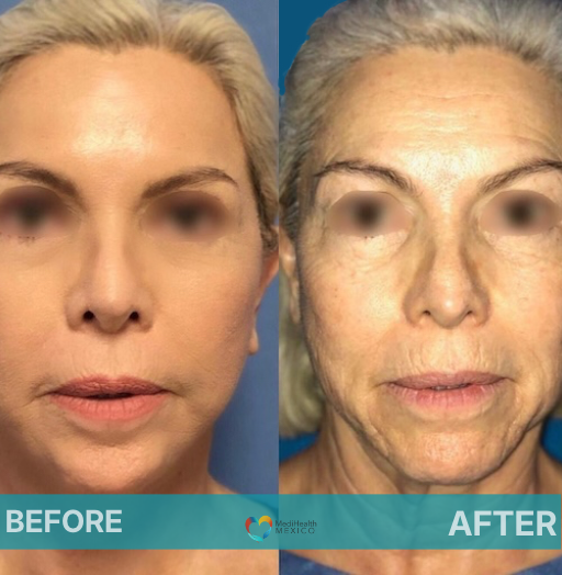 Facelift Tijuana