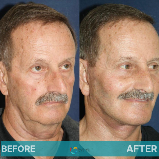 Facelift Before & After