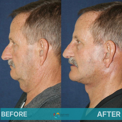 Facelift Before & After